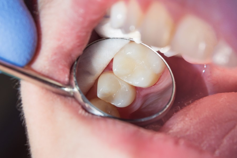 Close Up of Human Tooth with Mirror